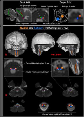 Three Dimensional Identification of Medial and Lateral Vestibulospinal Tract in the Human Brain: A Diffusion Tensor Imaging Study